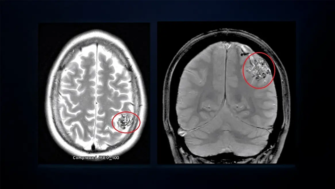 Two MRI brain scans with marked areas indicating tumor location in a pediatric patient