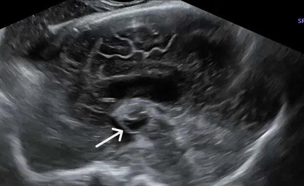 Ultrasound image highlighting a fetal brain abnormality with an arrow